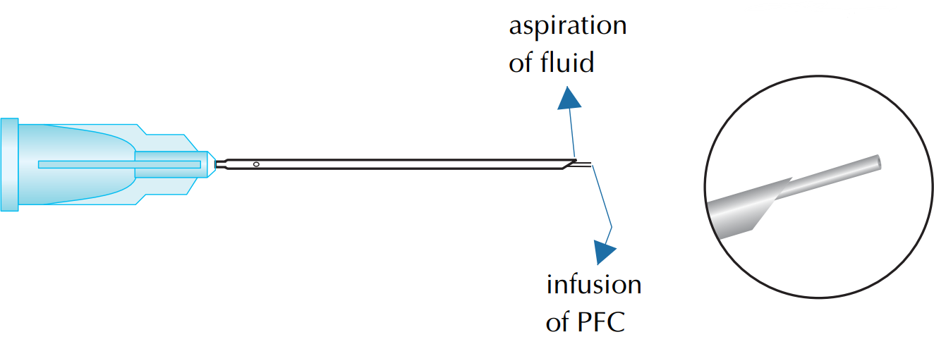 Pfcl I/A Cannula